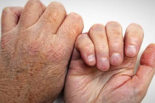 شیوع جذام در کشور کذب است