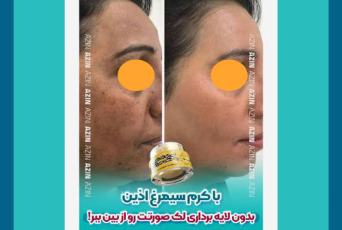 بهترین کرم ضدلک گیاهی