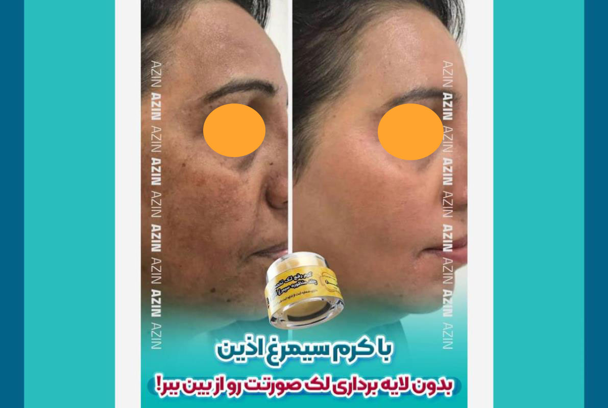 بهترین کرم ضدلک گیاهی