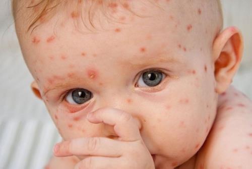 ابتلای خردسالان به آبله مرغان خطرناک نیست