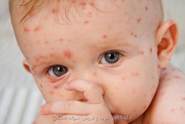 ابتلای خردسالان به آبله مرغان خطرناک نیست