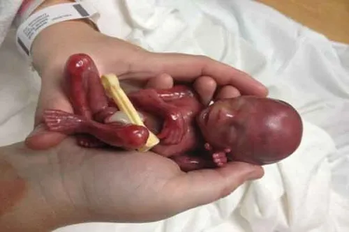 سقط جنین از صنعت پول های سیاه تا عوارض جبران ناپذیر جسمی و روانی