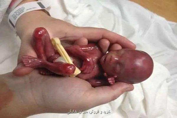 سقط جنین از صنعت پول های سیاه تا عوارض جبران ناپذیر جسمی و روانی