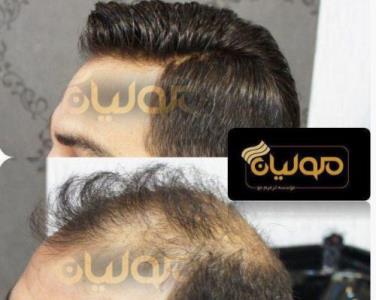 ترمیم مو بصورت تار به تار